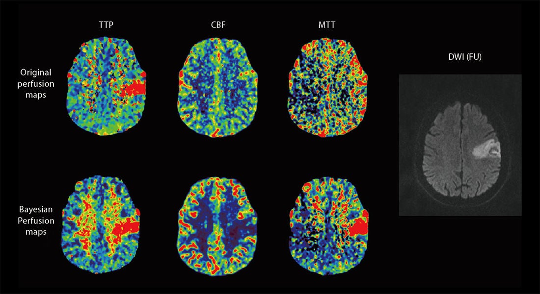 2020WP-Bayesian-CT-Perfusion-Imaging-in-Ischemic-Stroke