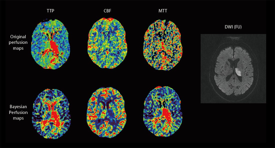 2020WP-Bayesian-CT-Perfusion-Imaging-in-Ischemic-Stroke