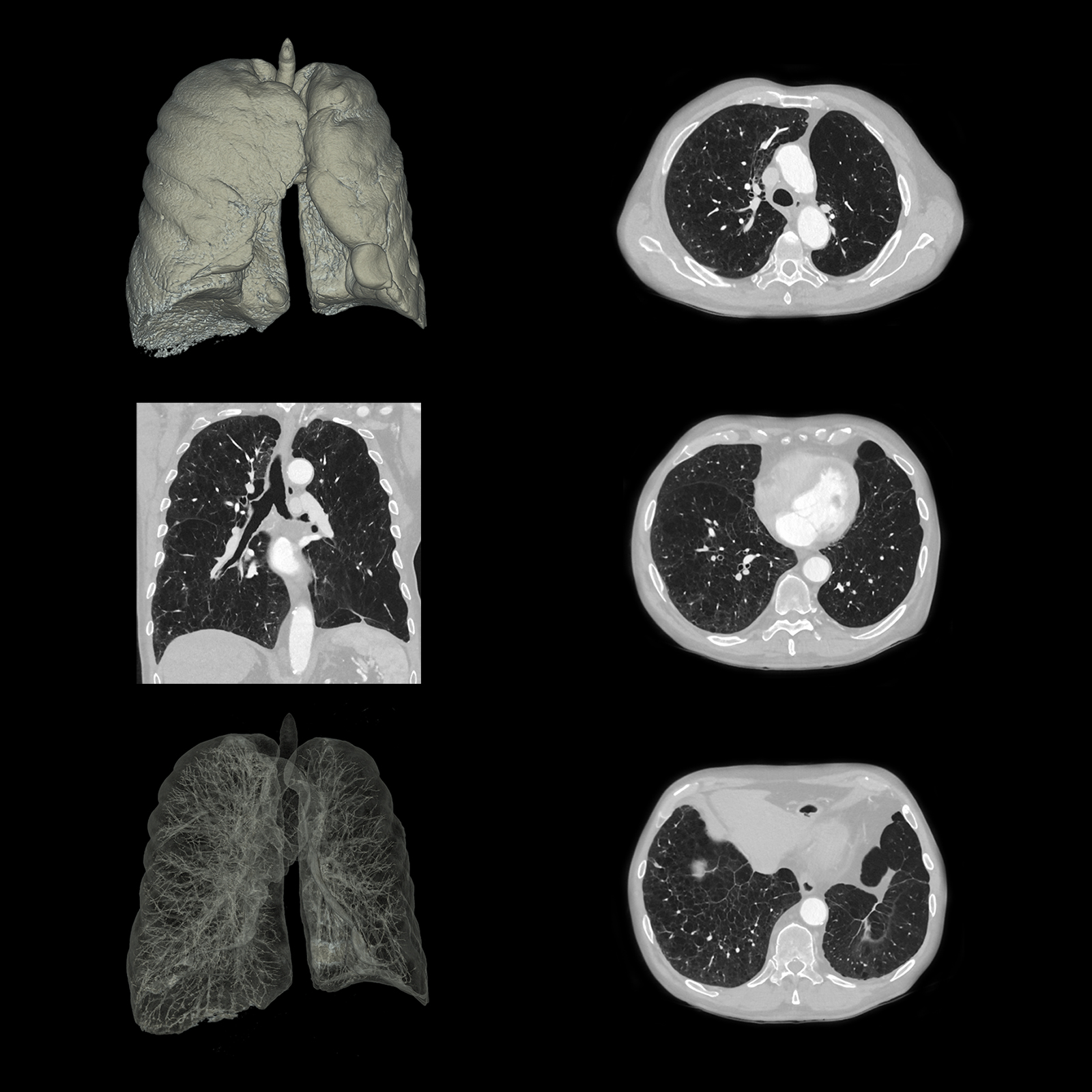 Aquilion ONE / PRISM Edition Lung Emphysema, AiCE