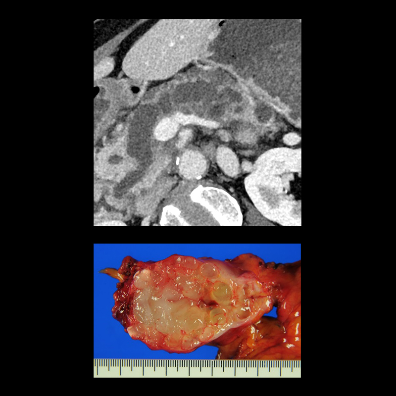 Aquilion Precision Pancreas Mixed-type Cancer, SHR, AiCE