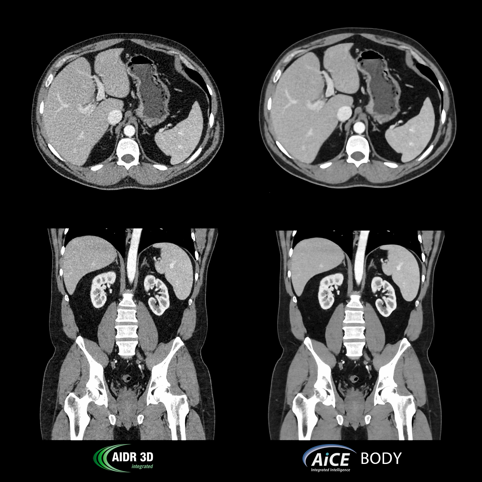 Aquilion Prime SP Abdomen Pelvis, AiCE