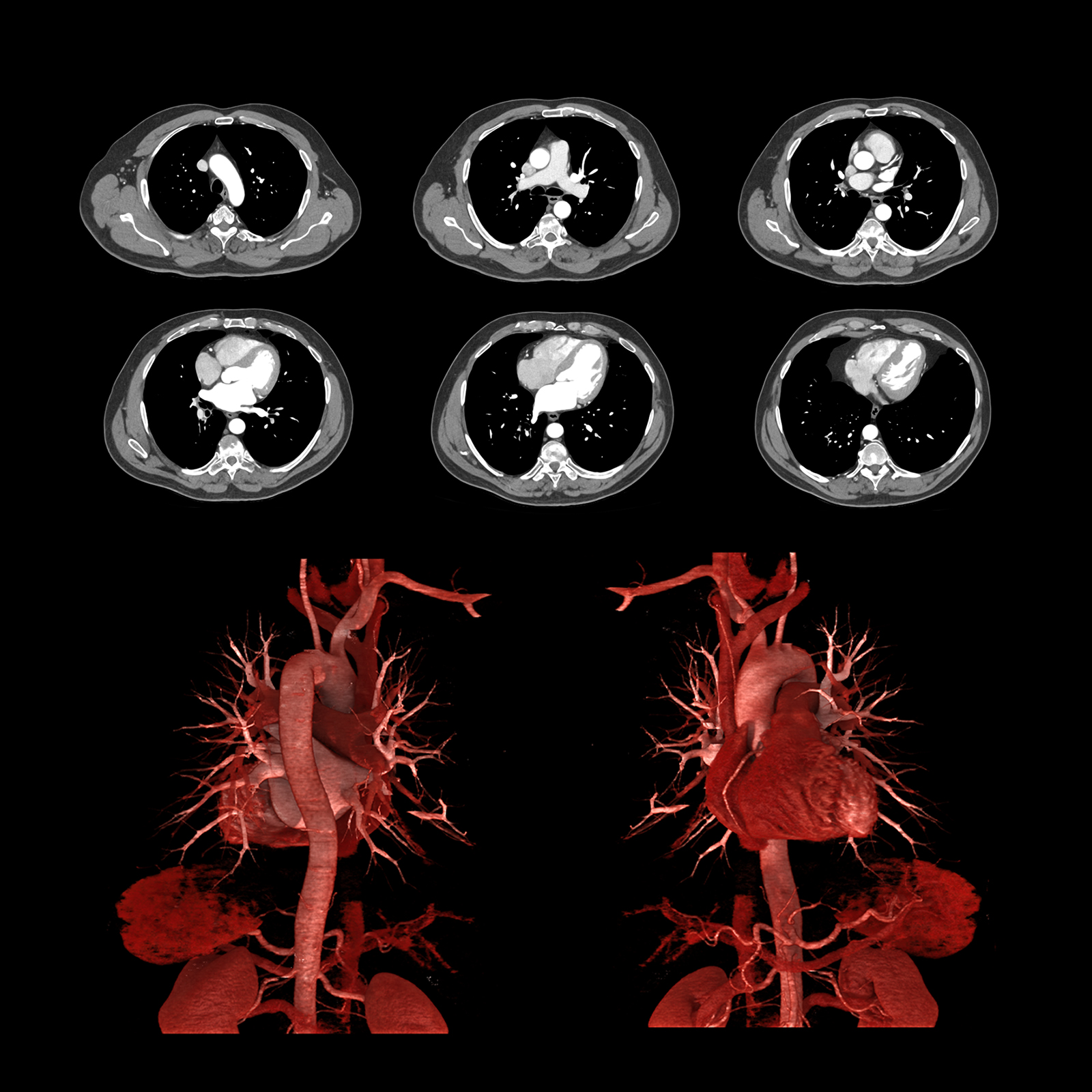 Aquilion ONE / PRISM Edition Chest Pain Assessment, Gated, AiCE