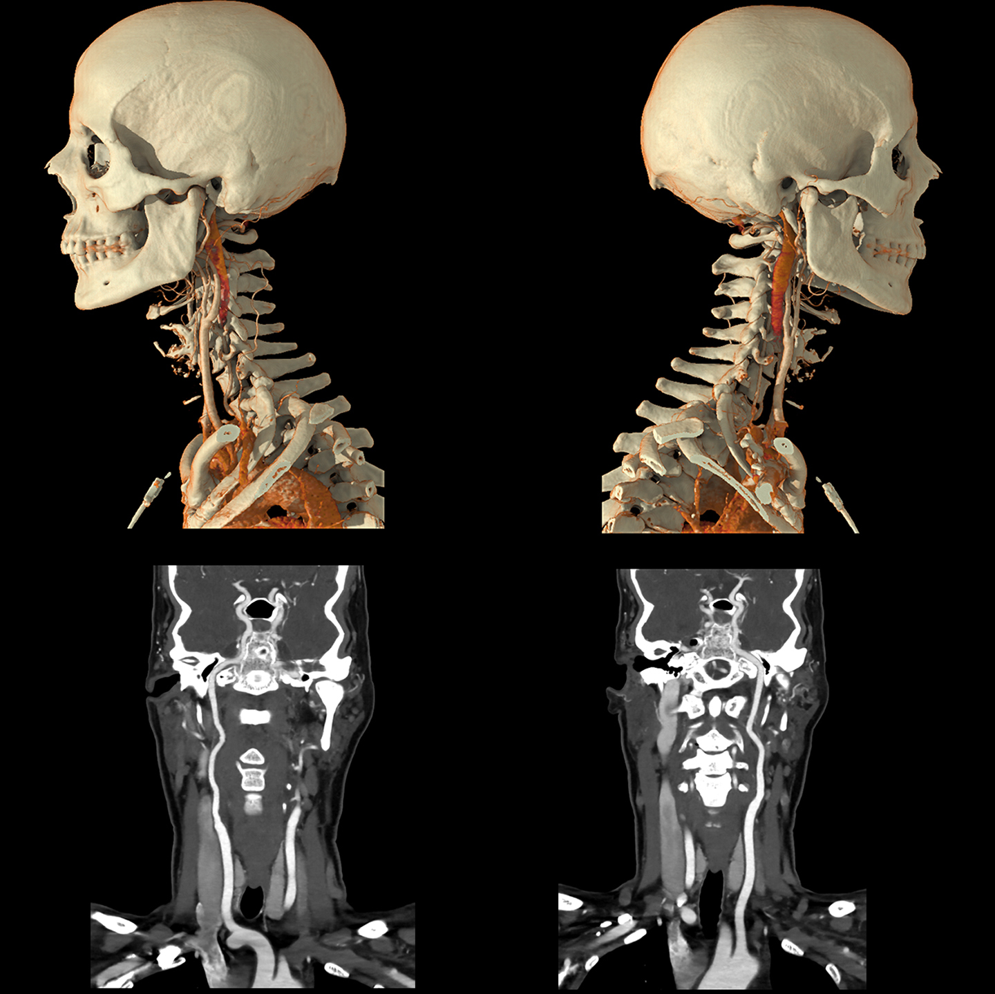 Aquilion ONE / PRISM Edition Carotid Angiography, AiCE