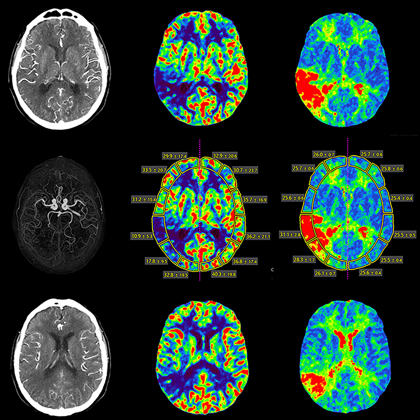 Aquilion ONE / PRISM Edition Brain Perfusion Right Occlusion, Volume, AiCE