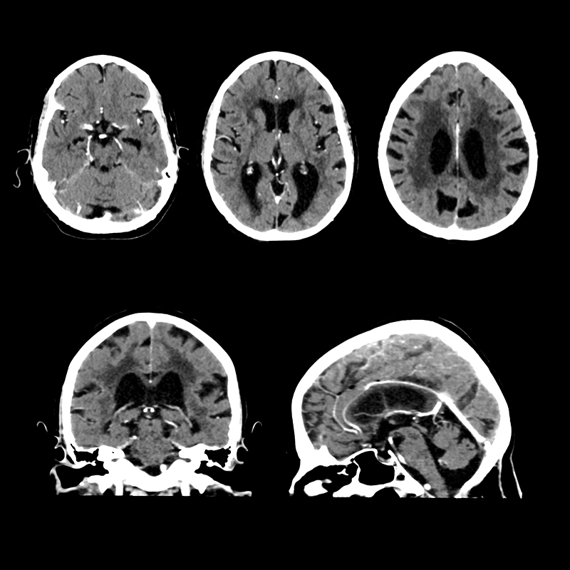 Aquilion Prime SP Brain, AiCE