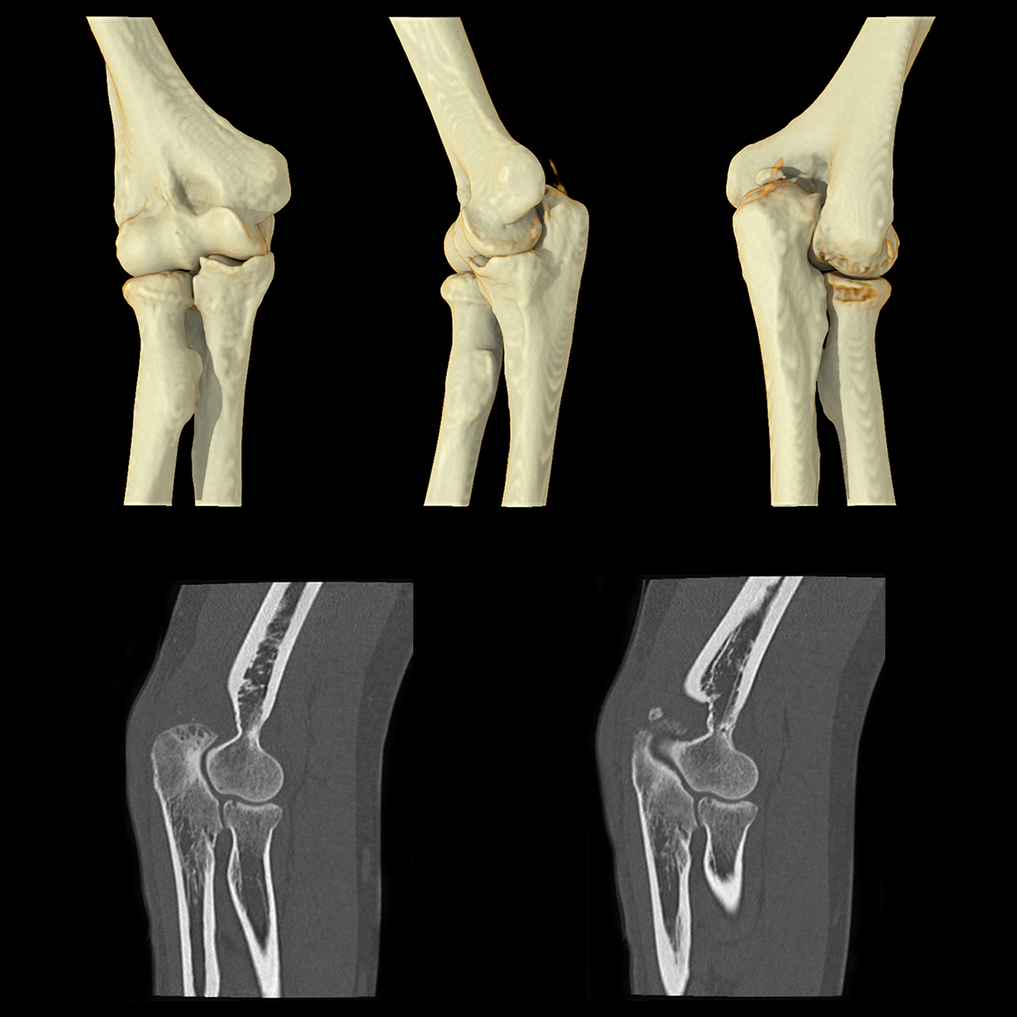 Aquilion ONE / PRISM Edition Elbow Fracture Acromion Process, Volume, AiCE*
