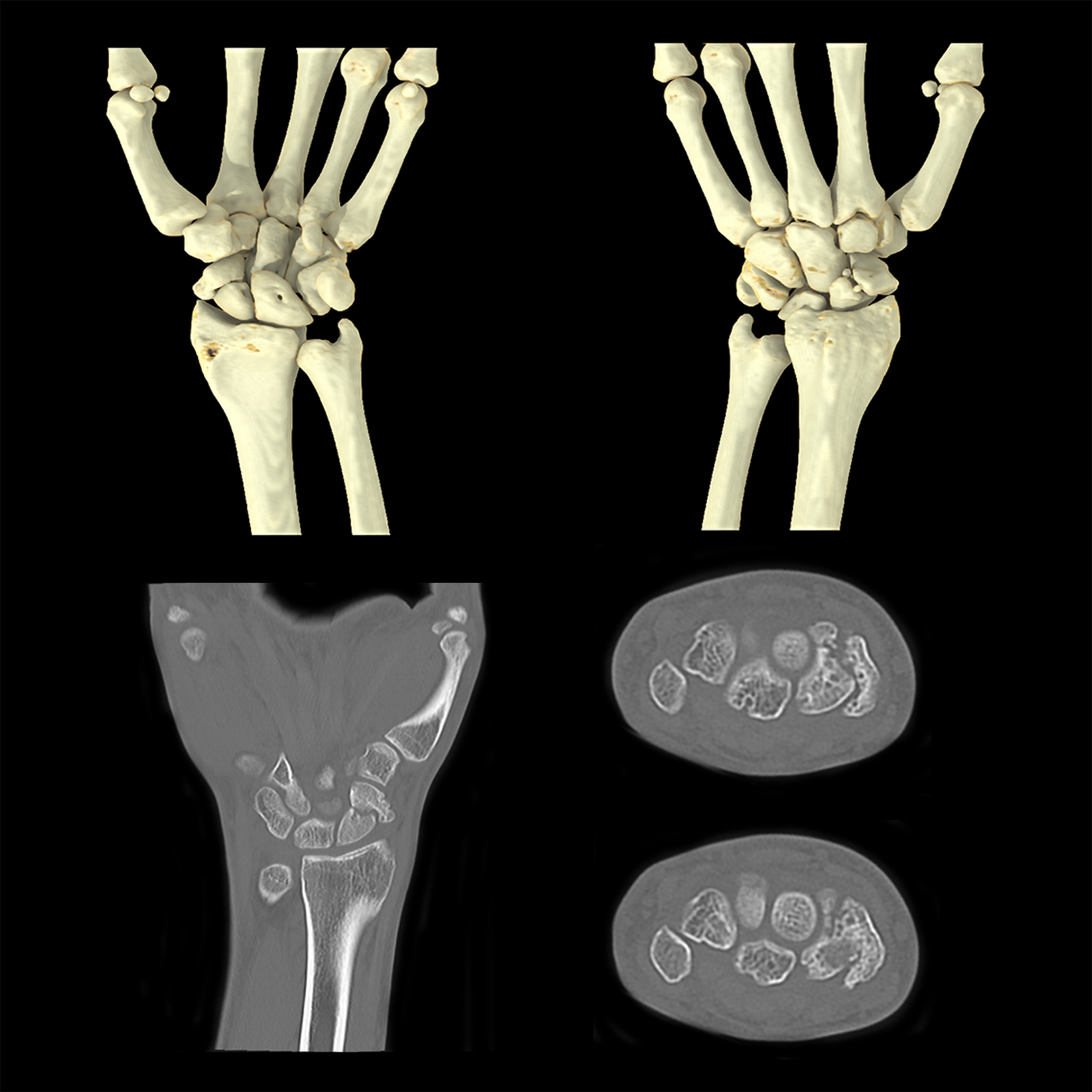 Aquilion ONE / GENESIS Edition Wrist Scaphoid Fracture, AiCE