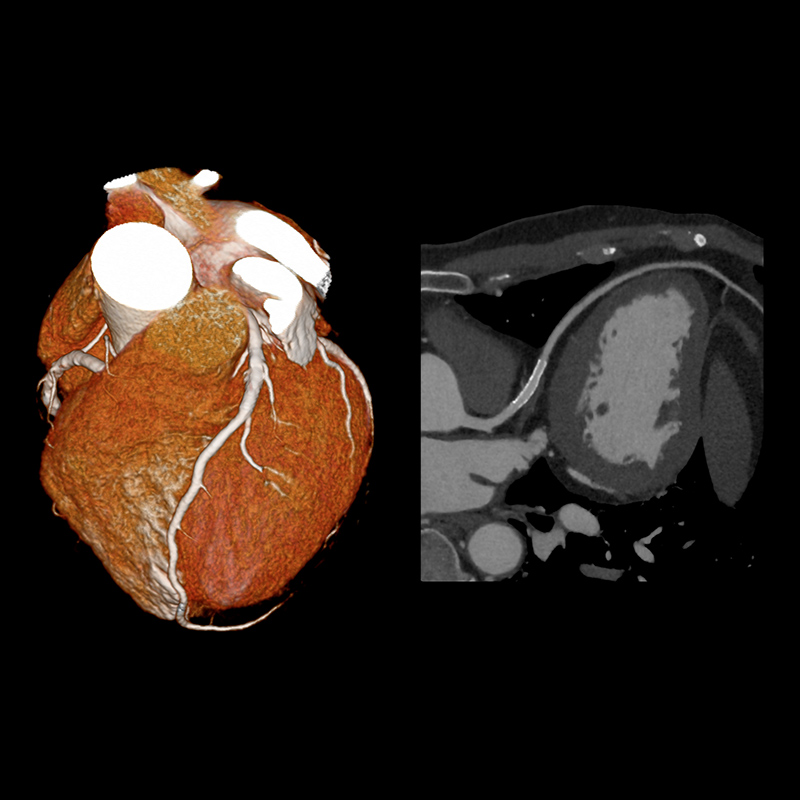 Aquilion ONE / GENESIS Edition AiCE LAD Stent