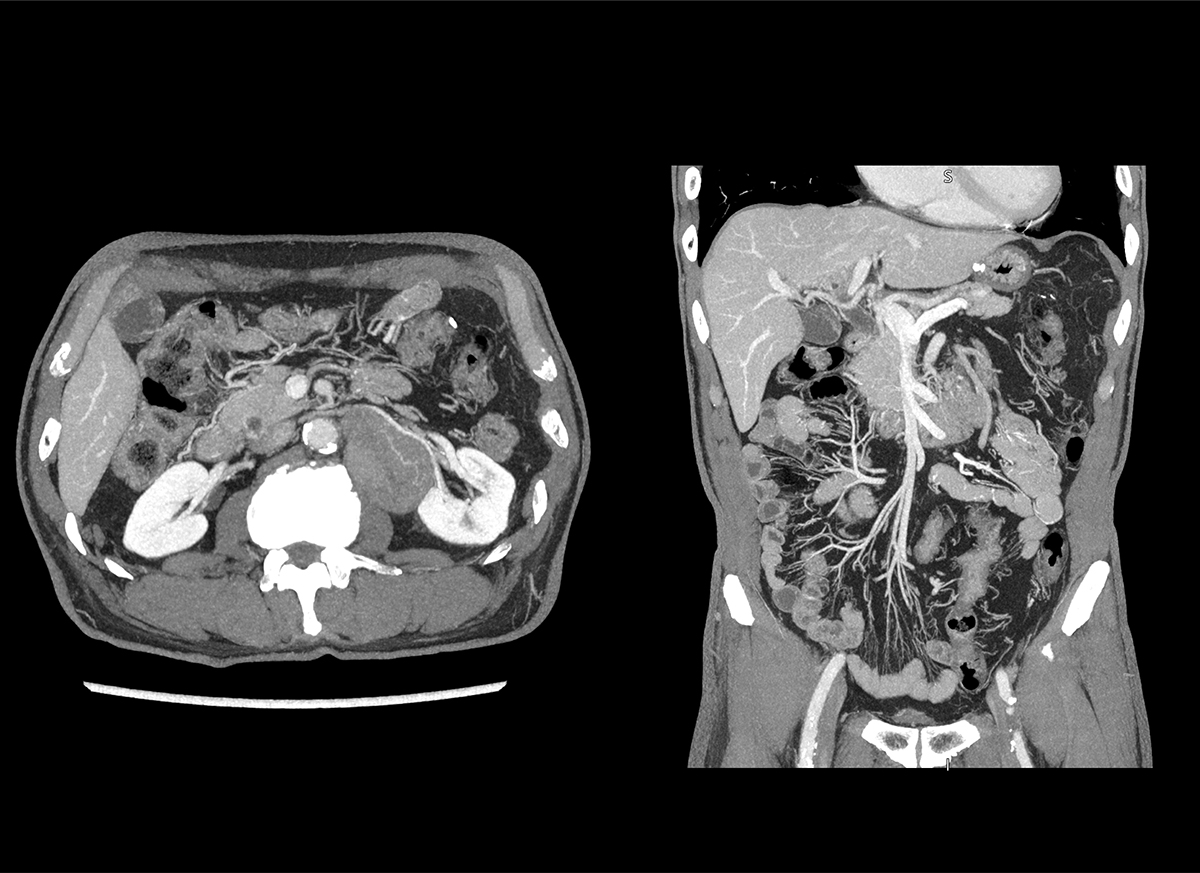 Photon Counting CT Oncology