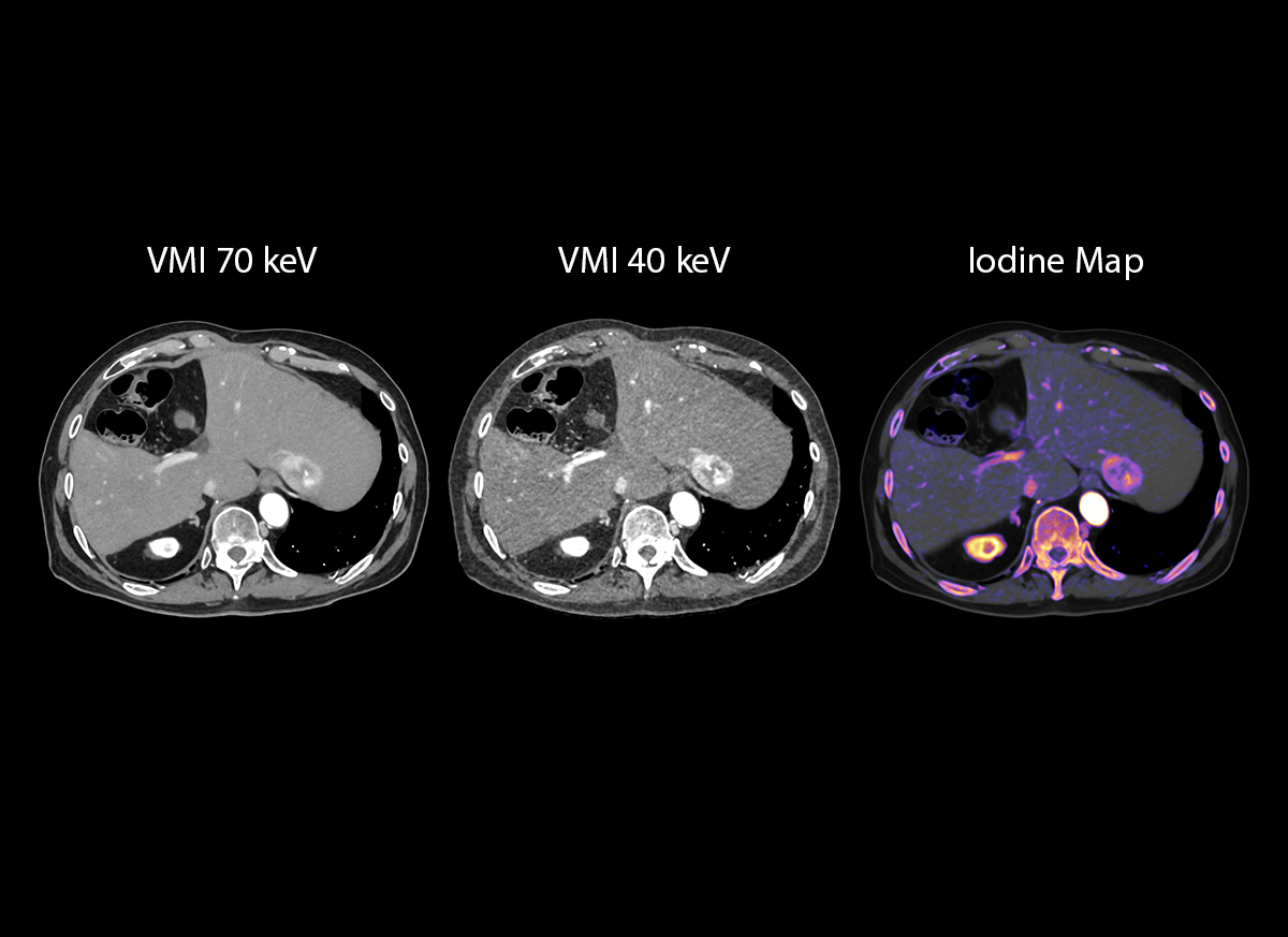 Photon Counting CT Liver Tumor