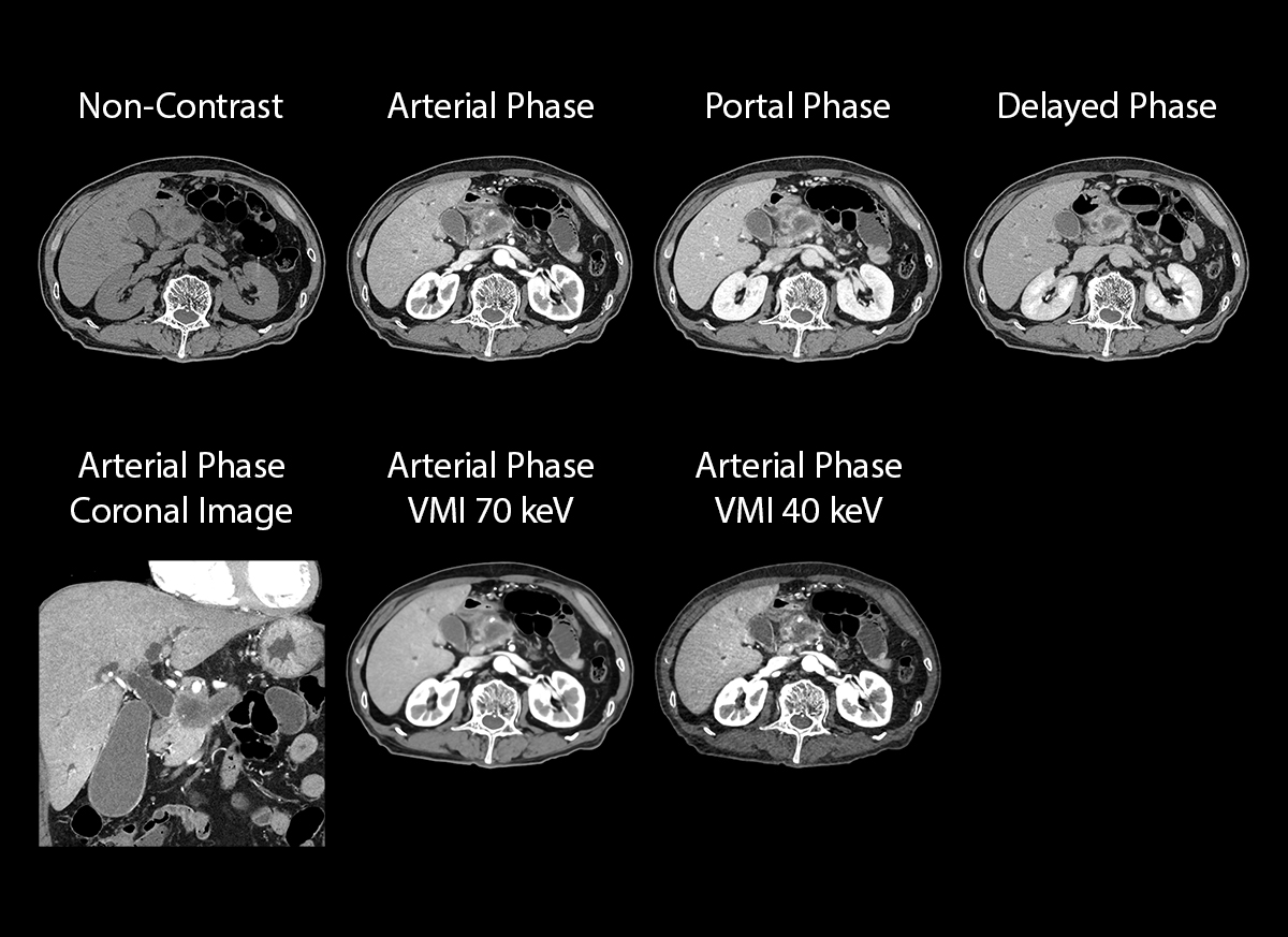 Photon Counting CT Multi Phase Imaging