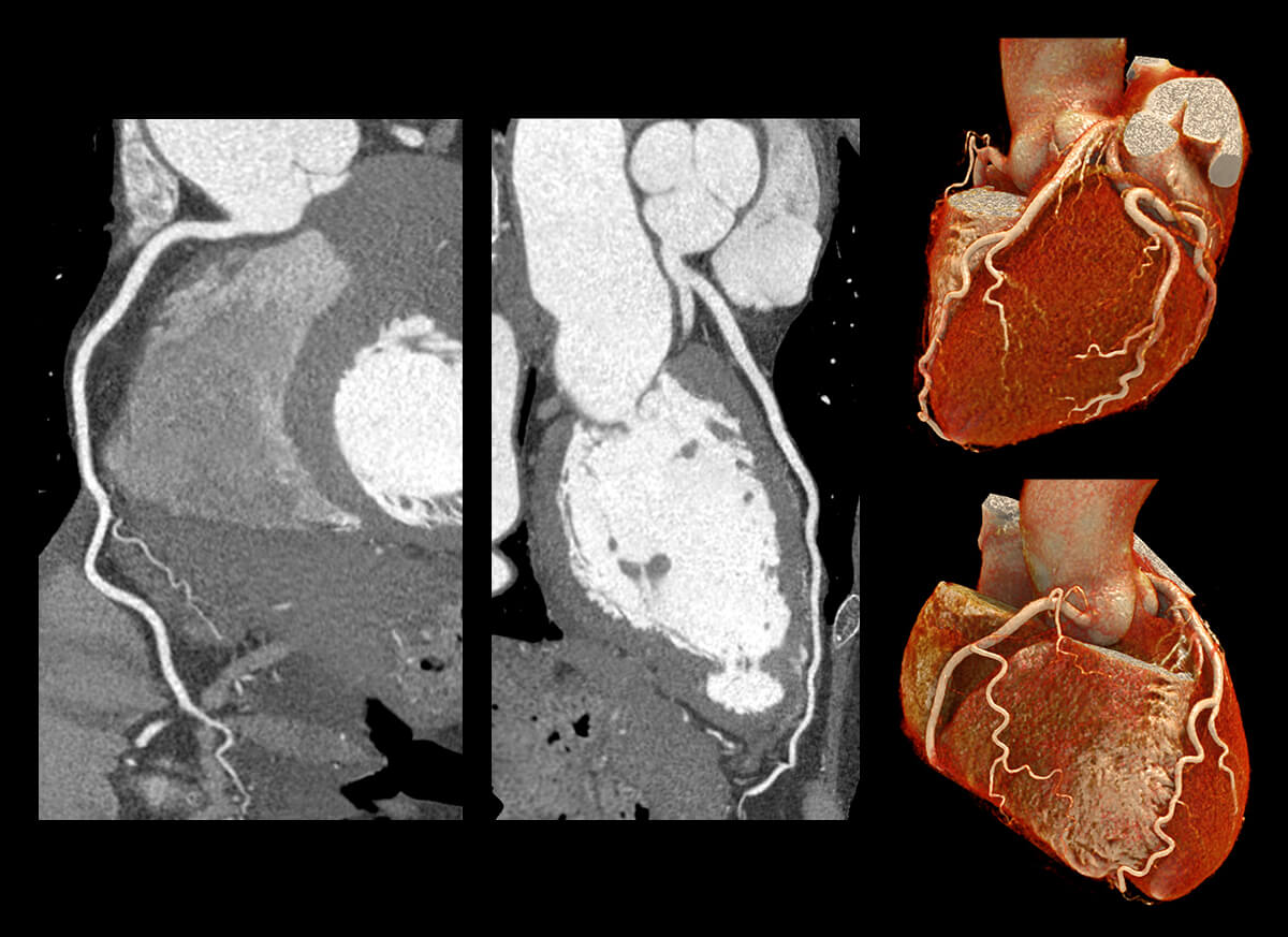 Coronary artery