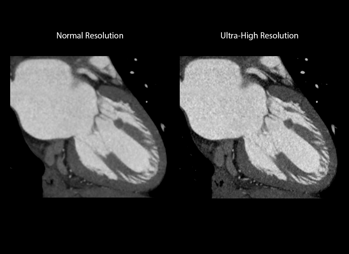 Photon Counting CT Papillary muscle and chordae tendinea