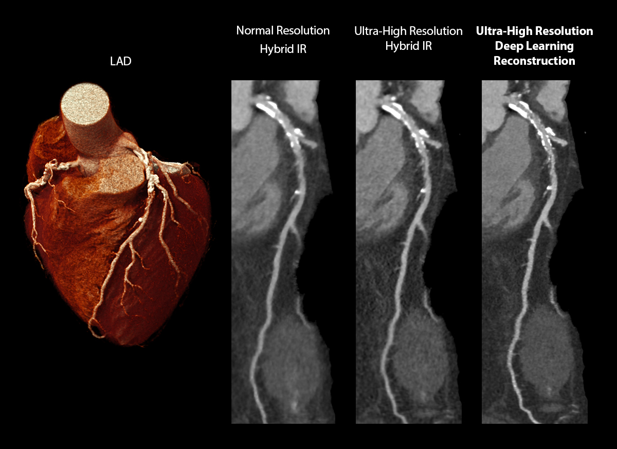 Severely Calcified Coronary Arteries