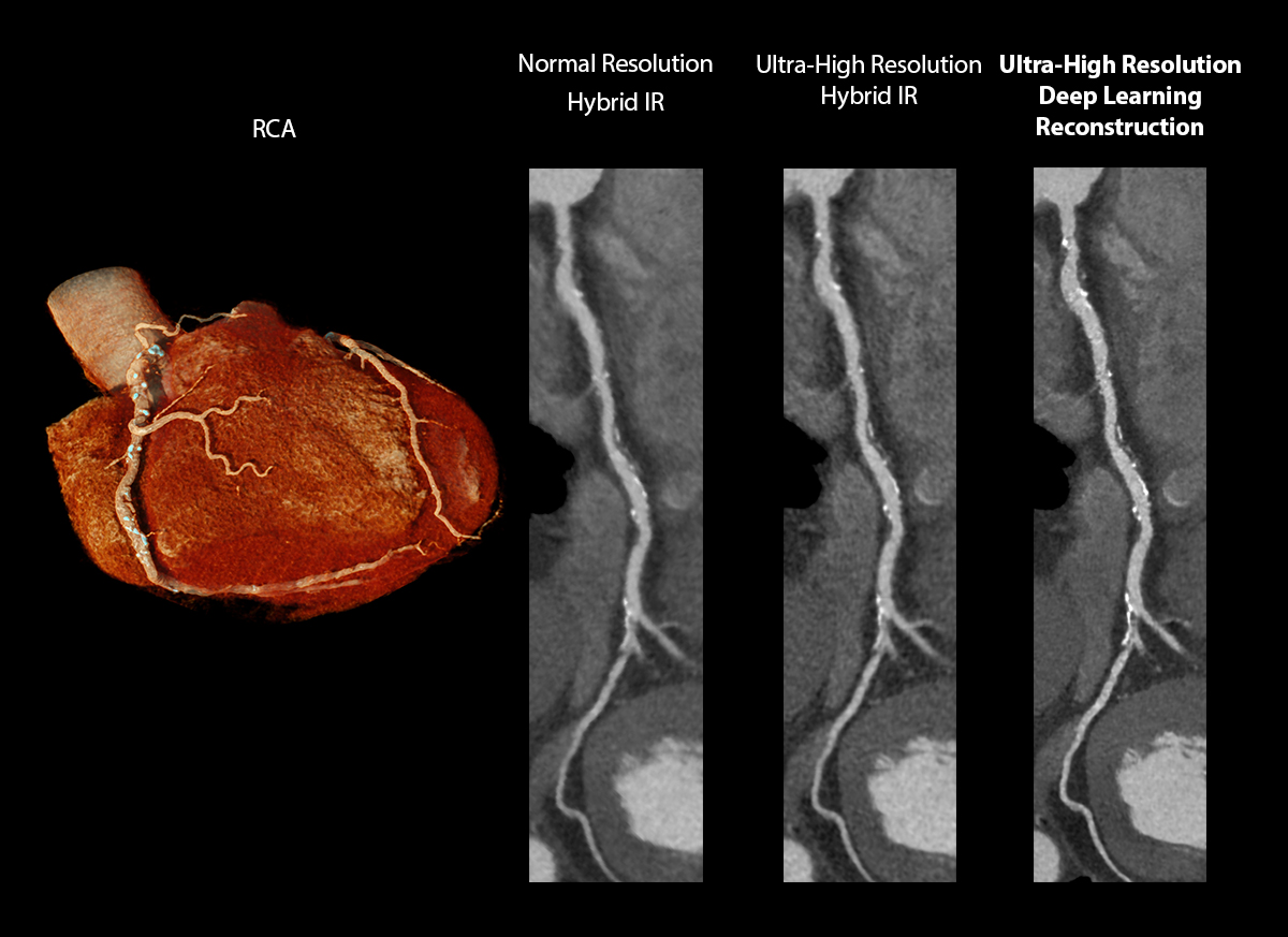 Severely Calcified Coronary Arteries