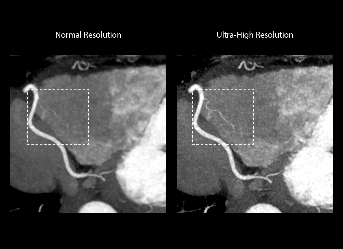 Coronary artery