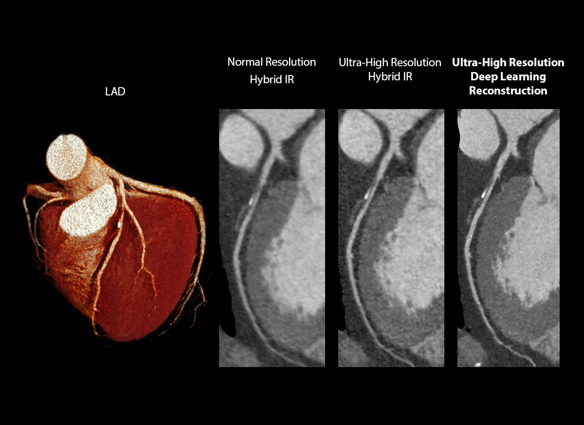 Left Anterior Descending Artery Plaque