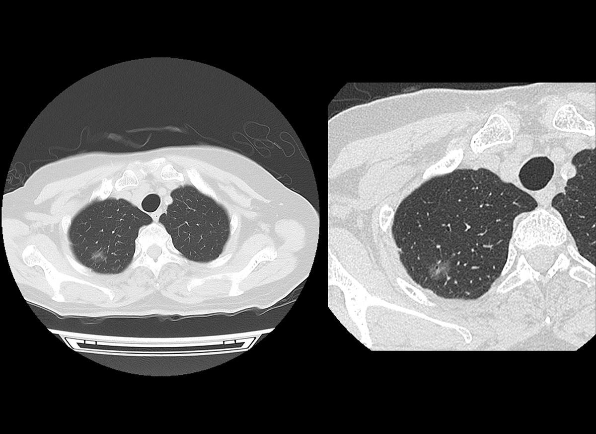 Photon Counting CT Chest6
