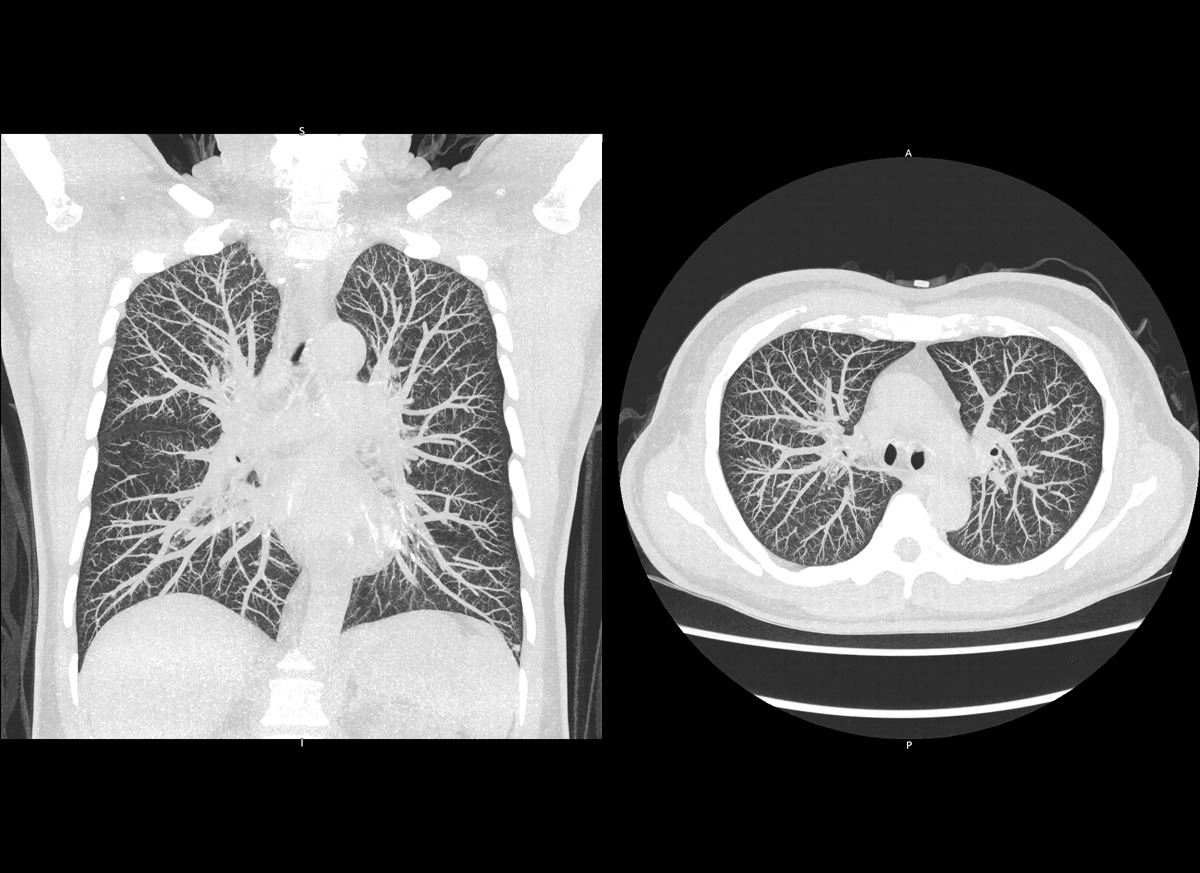 Photon Counting CT Chest3