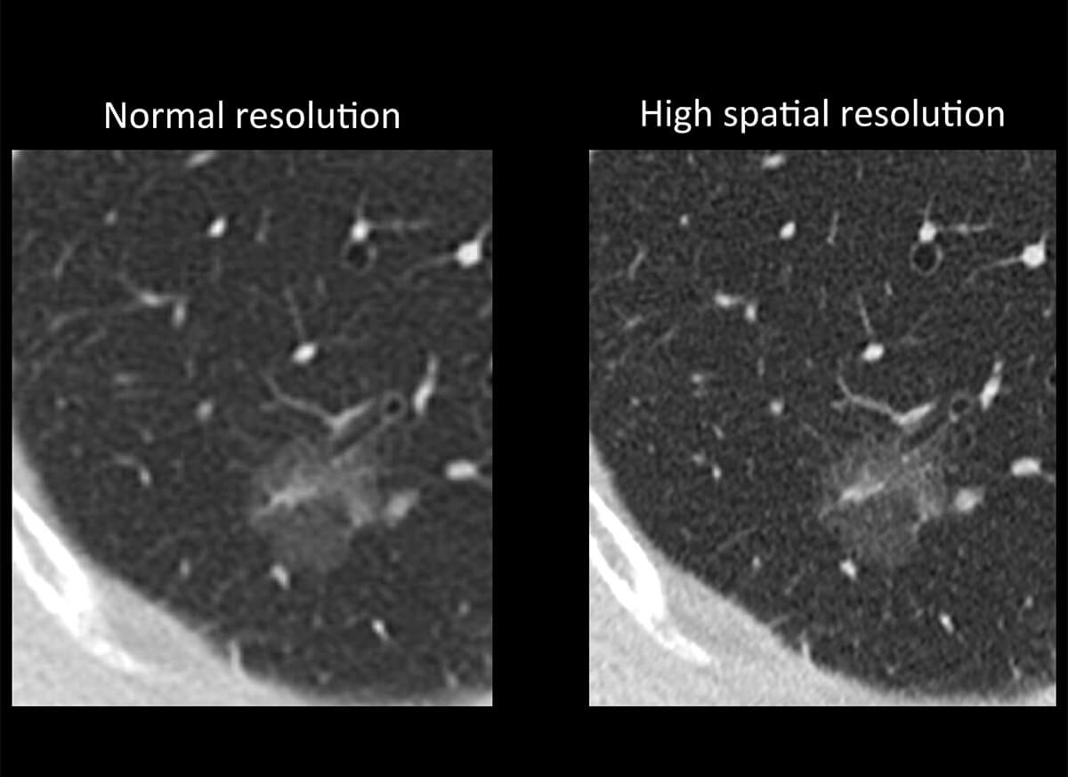 Photon Counting CT Chest2