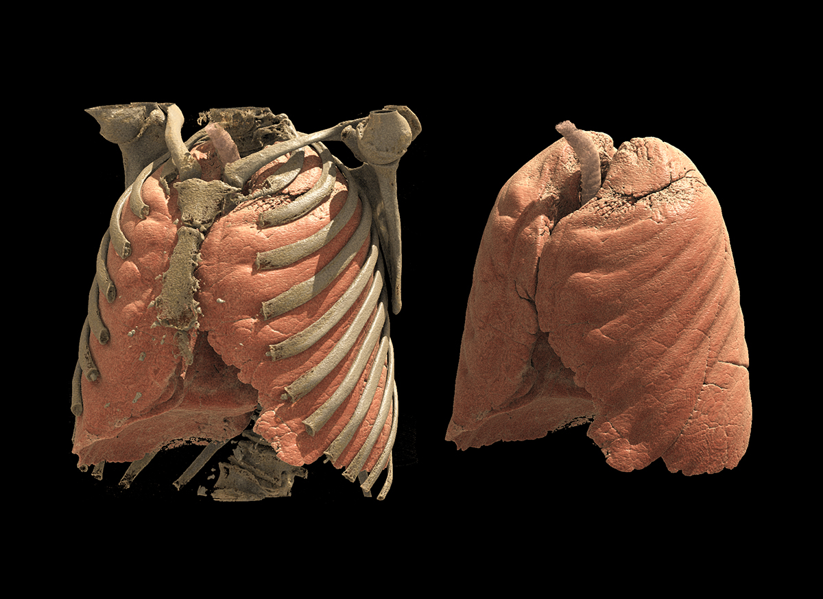 Photon Counting CT Chest5