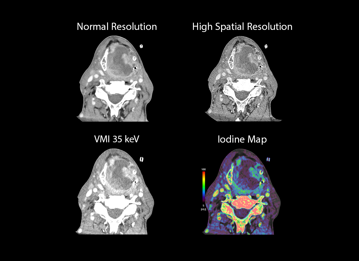 Photon Counting CT Pharyngeal Cancer
