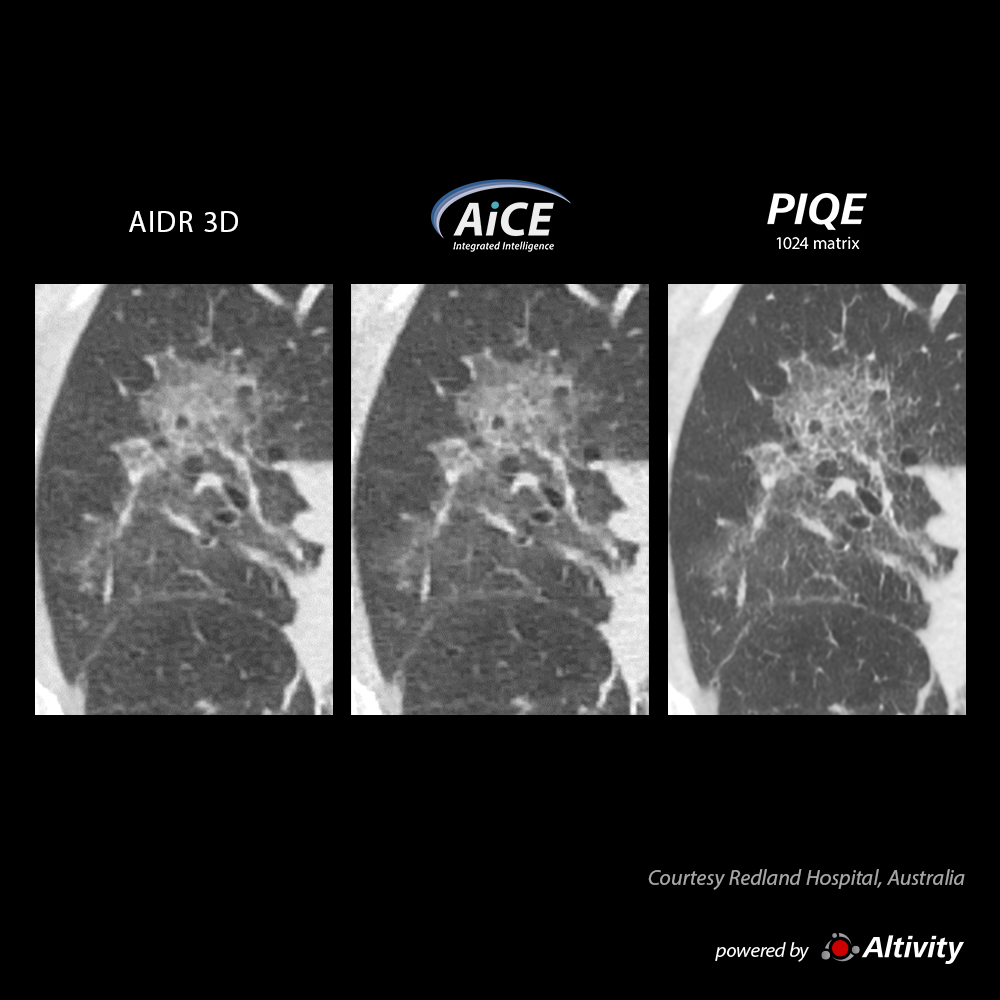 Precise IQ Engine Venous Phase Chest